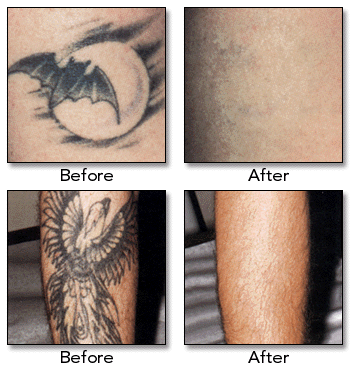 Tattoo Removal Archives  The Laser Lounge Spa